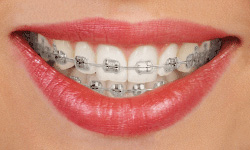 Orthodontics ON Canada
